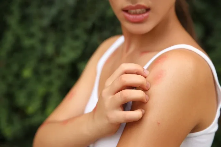 mosquito bite